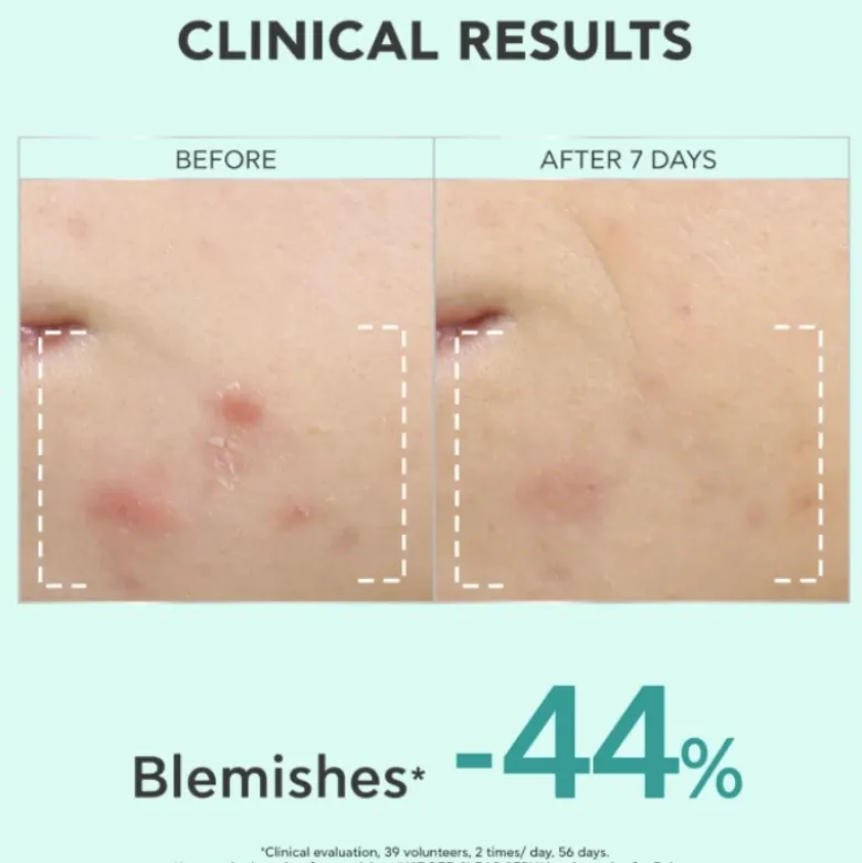 Apivita Just Bee Clear Sérum Anti-Imperfeições 30ml | Atenua Marcas Acne e Afina a Pele